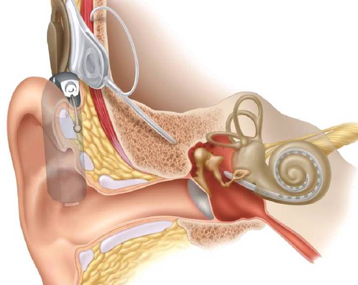 Cochlear Implant (The Bionic Ear) | St Vincents ENT
