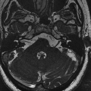 A left sided vestibular schwannoma (acoustic neuroma) which remains within the internal auditory canal. There is no contact with the brain and these tumours are often treated conservatively. This means a MRI scan is repeated at regular intervals to ensure that there is no growth