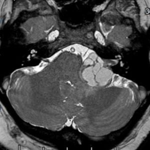 A moderate-large left sided vestibular schwannoma (acoustic neuroma). The imaging characteristics of this scan indicate that a large proportion of the tumour is fluid filled, or cystic. Cystic tumours usually have a faster growth rate. This tumour can be seen compressing the cerebellar peduncle with effacement of the 4th ventricle.